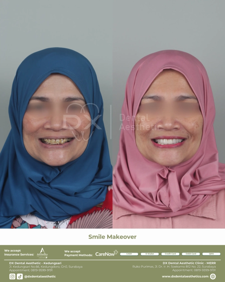 Before After 01 - Dental Microscopes by Eighteeth - DX Dental Aesthetic