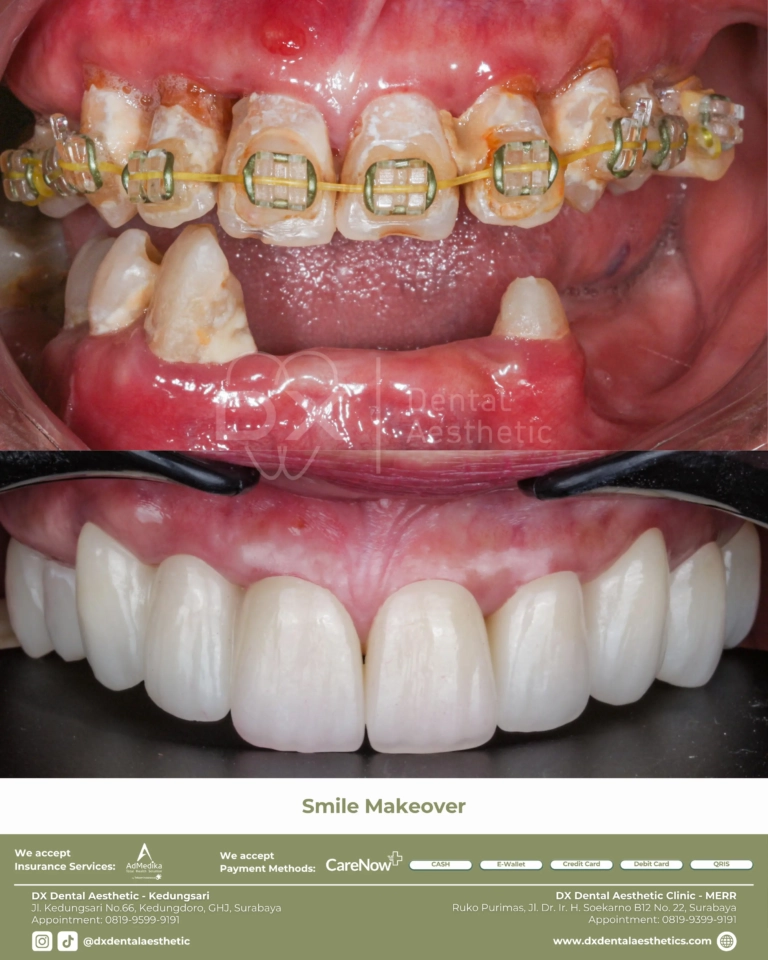 Before After 02 - Dental Microscopes by Eighteeth - DX Dental Aesthetic