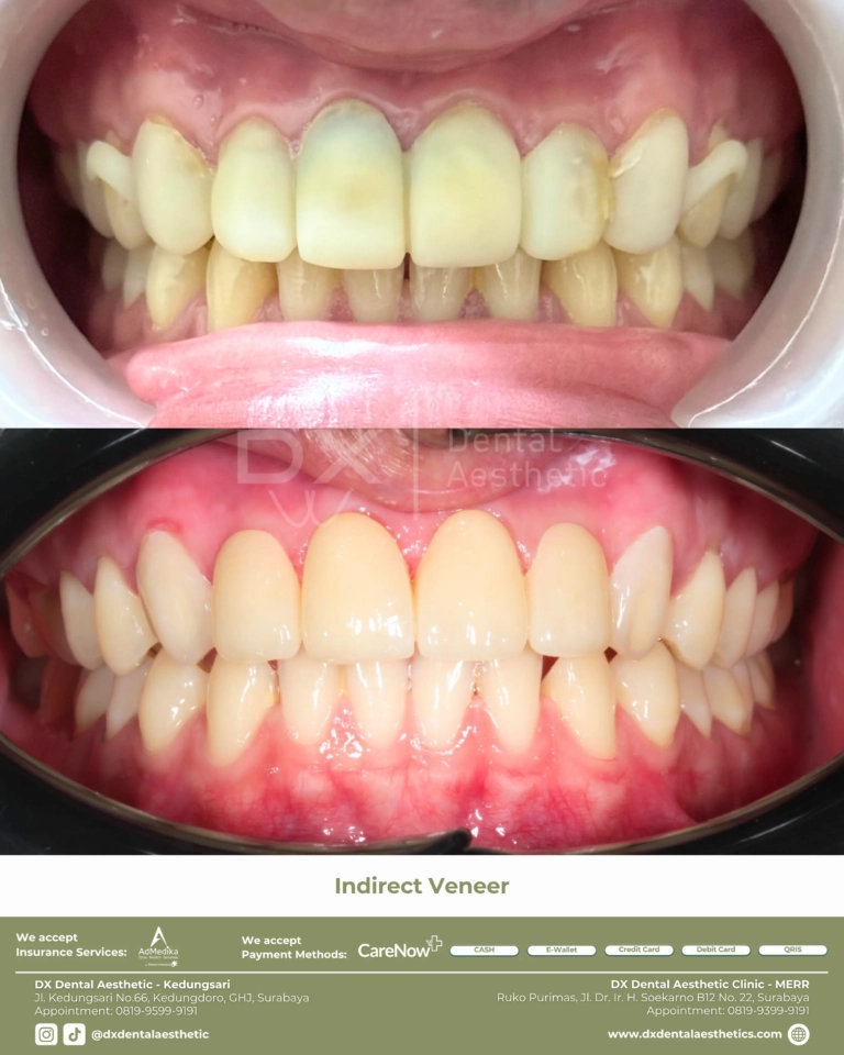 Before After 03 - Dental Microscopes by Eighteeth - DX Dental Aesthetic