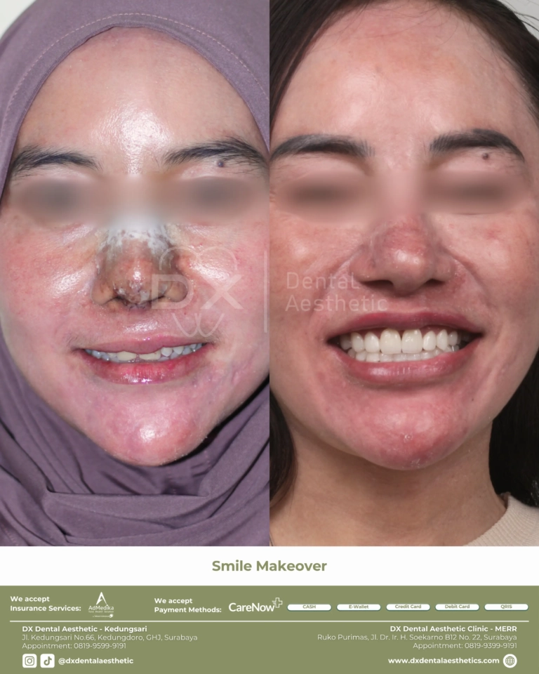 Before After 04 - Dental Microscopes by Eighteeth - DX Dental Aesthetic