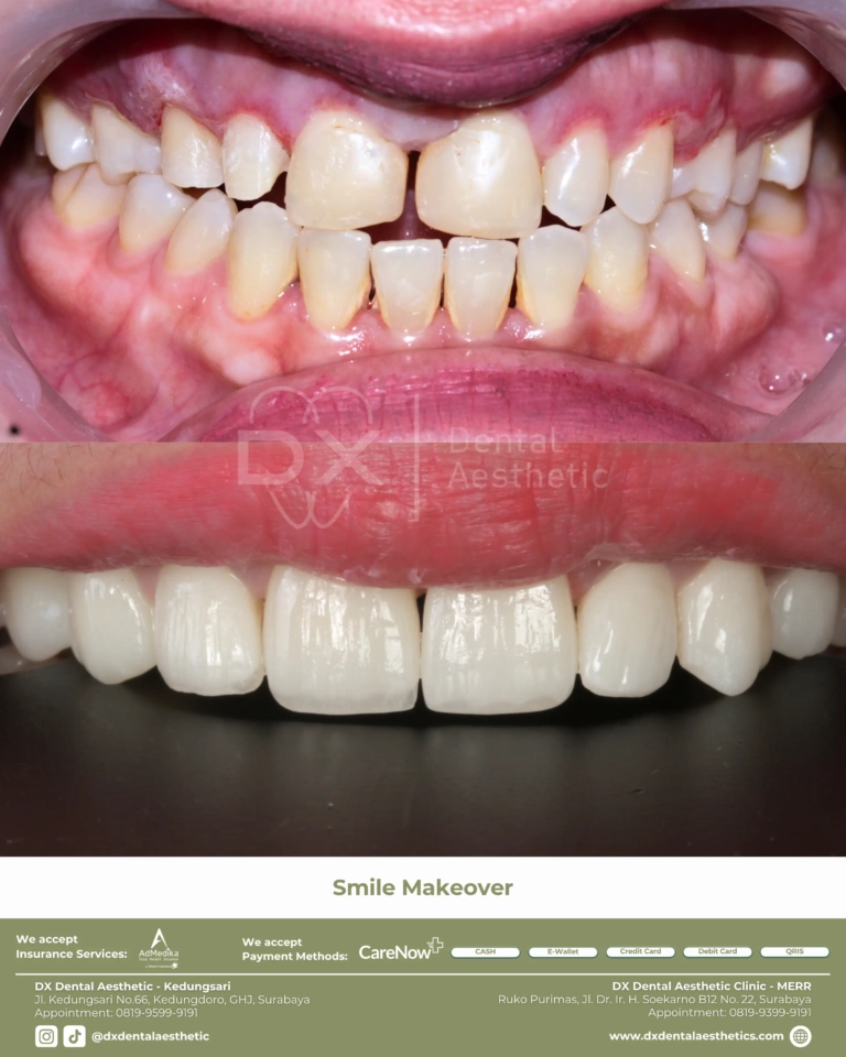 Before After 05 - Dental Microscopes by Eighteeth - DX Dental Aesthetic