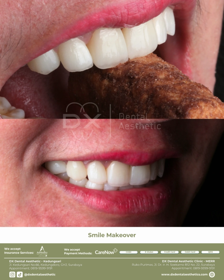 Before After 06 - Dental Microscopes by Eighteeth - DX Dental Aesthetic