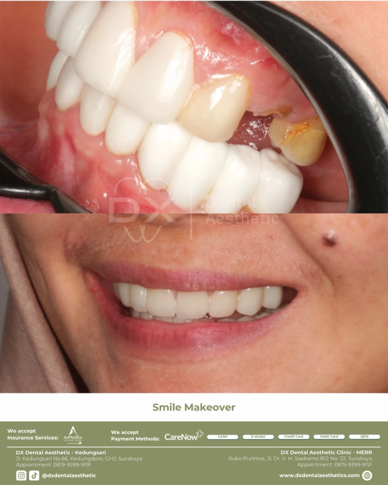 Before After 08 - Dental Microscopes by Eighteeth - DX Dental Aesthetic