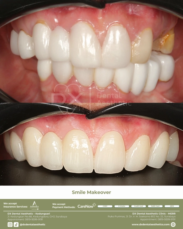 Before After 09 - Dental Microscopes by Eighteeth - DX Dental Aesthetic