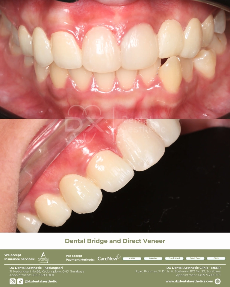 Before After 11 - Dental Microscopes by Eighteeth - DX Dental Aesthetic