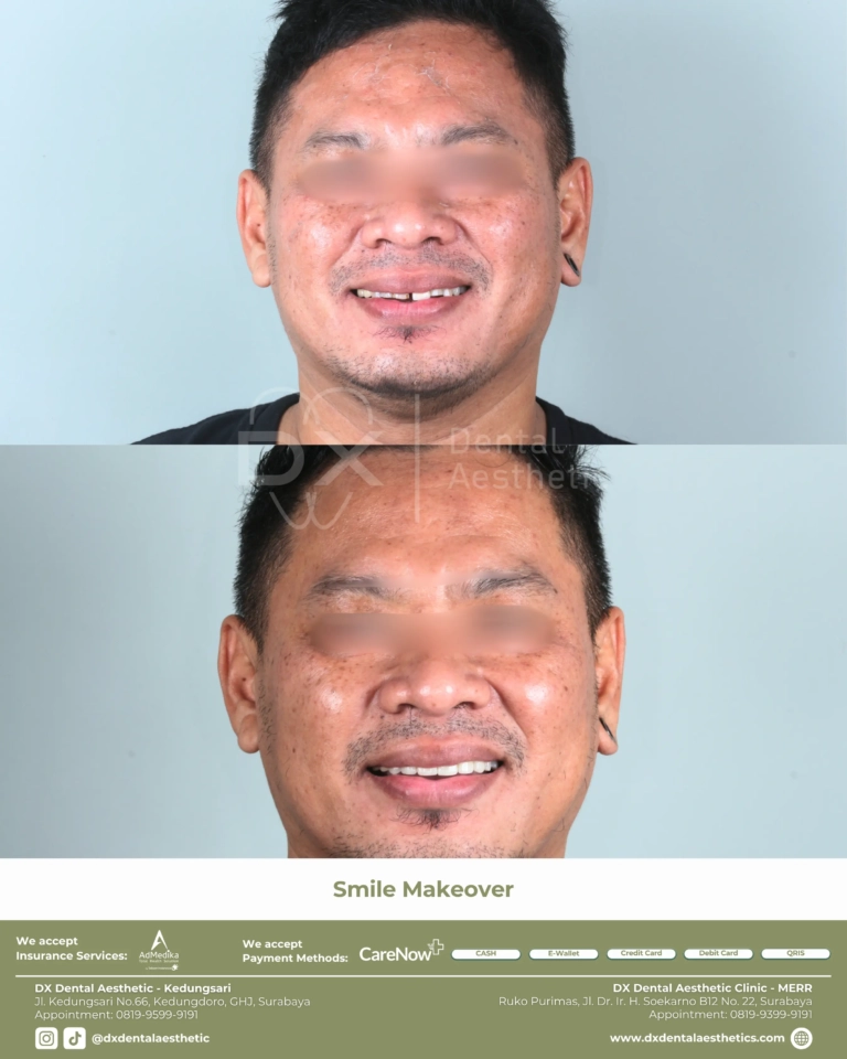 Before After 13 - Dental Microscopes by Eighteeth - DX Dental Aesthetic