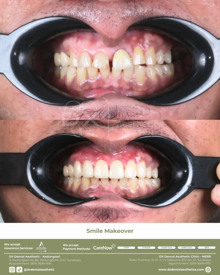 Before After 14 - Dental Microscopes by Eighteeth - DX Dental Aesthetic