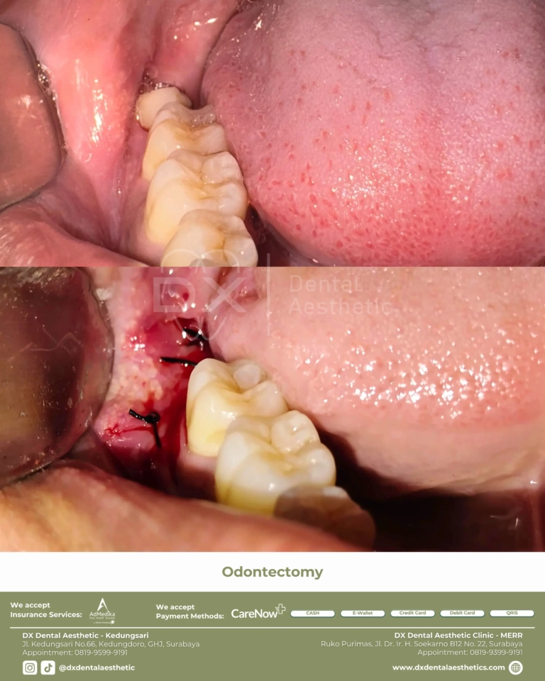 Before After 15 - Dental Microscopes by Eighteeth - DX Dental Aesthetic