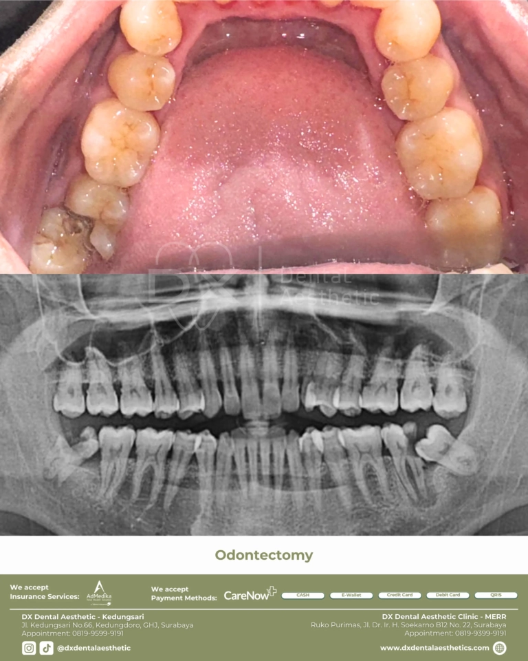 Before After 16 - Dental Microscopes by Eighteeth - DX Dental Aesthetic