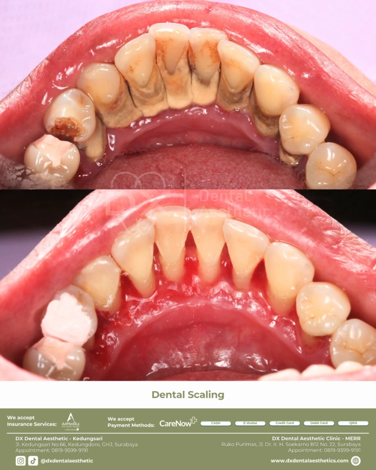 Before After 17 - Dental Microscopes by Eighteeth - DX Dental Aesthetic